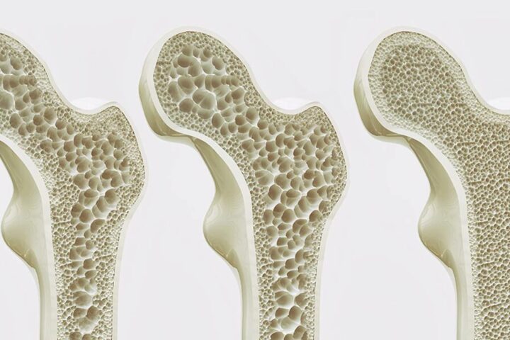 osteoporosi composizione ossea