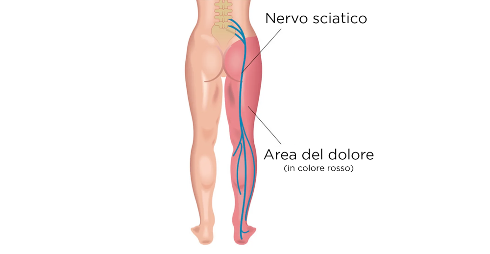 immagine di che cos'è il nervo sciatico e della zona di dove si percepisce il dolore 