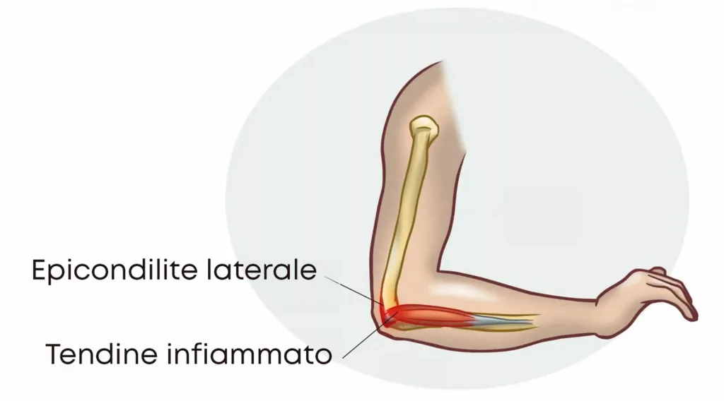 schema anatomico dell'epicondilite laterale e del tendine infiammato