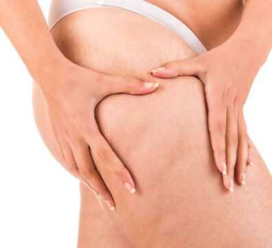 Donna che schiaccia la coscia con le mani, evidenziando la presenza di cellulite sulla pelle.