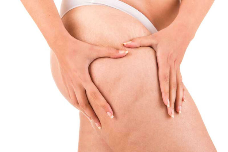 Donna che schiaccia la coscia con le mani, evidenziando la presenza di cellulite sulla pelle.