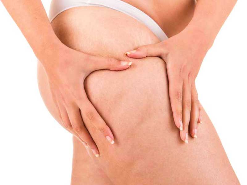 Donna che schiaccia la coscia con le mani, evidenziando la presenza di cellulite sulla pelle.
